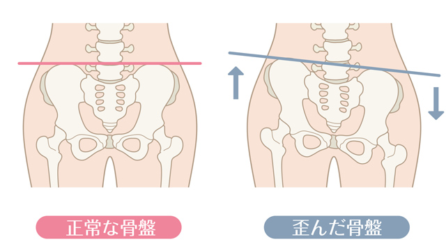 骨盤のゆがみを当整体院で矯正、改善