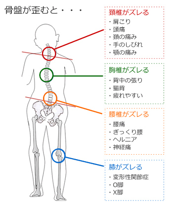 骨盤の歪みで腰痛・ぎっくり腰、頭痛、坐骨神経痛などが発生